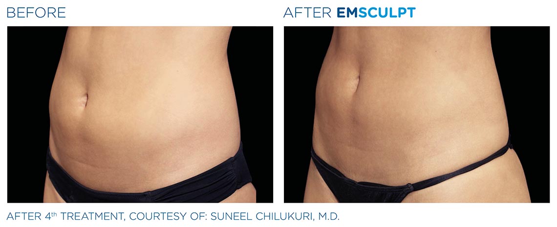 abdomen before and after 4th emsculpt treatment