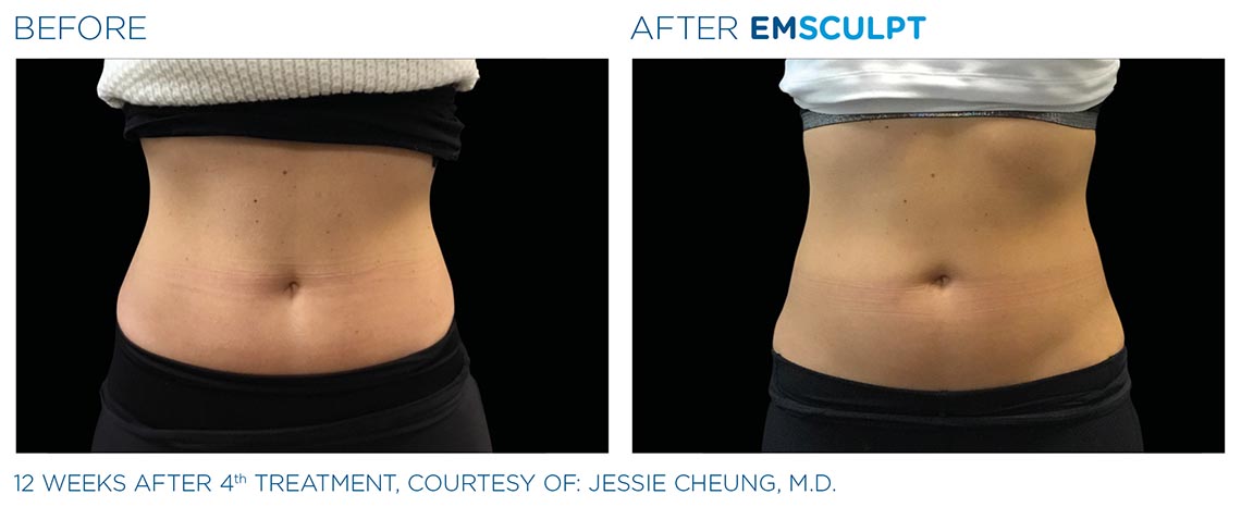 abdomen before and after 12 weeks, 4th emsculpt treatment