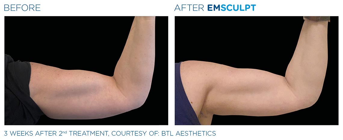 bicep before and after 3 weeks, 2nd emsculpt treatment