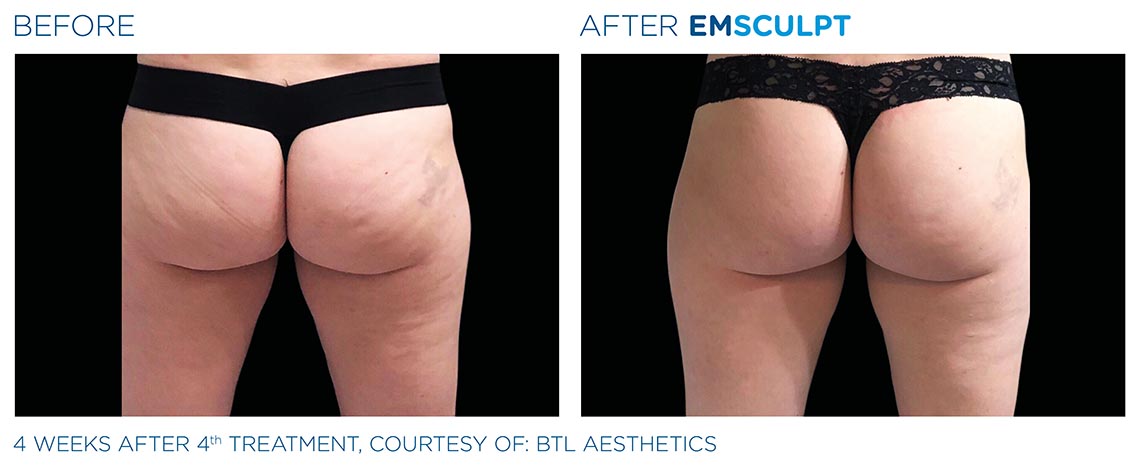 glutes before and after 4 weeks, 4th emculpt treatment