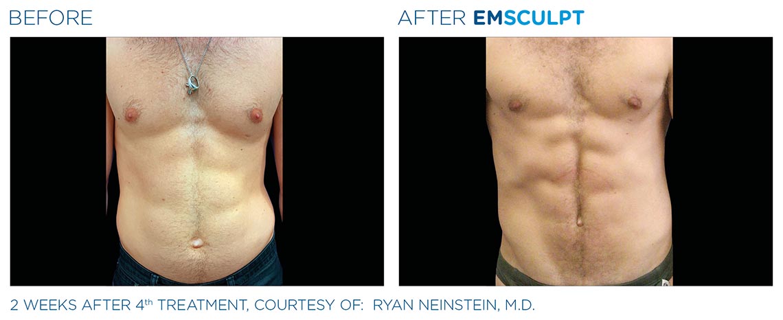 male abdomen before and after 2 weeks, 4th emsculpt treatment