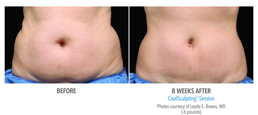 Before and After 2 with Coolsculpting