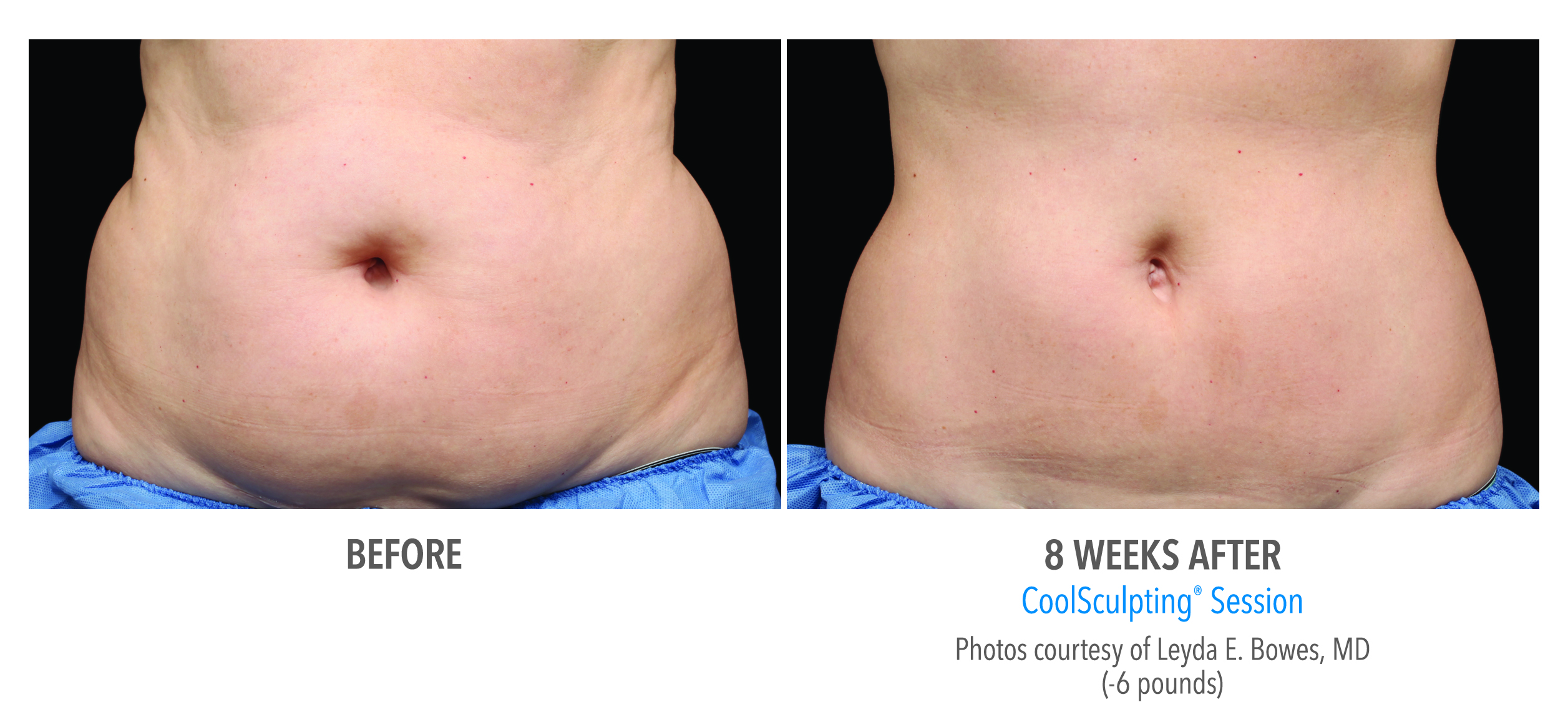 CoolSculpting for Stomach, Belly Fat & Abs , CoolSculpting vs Liposuction