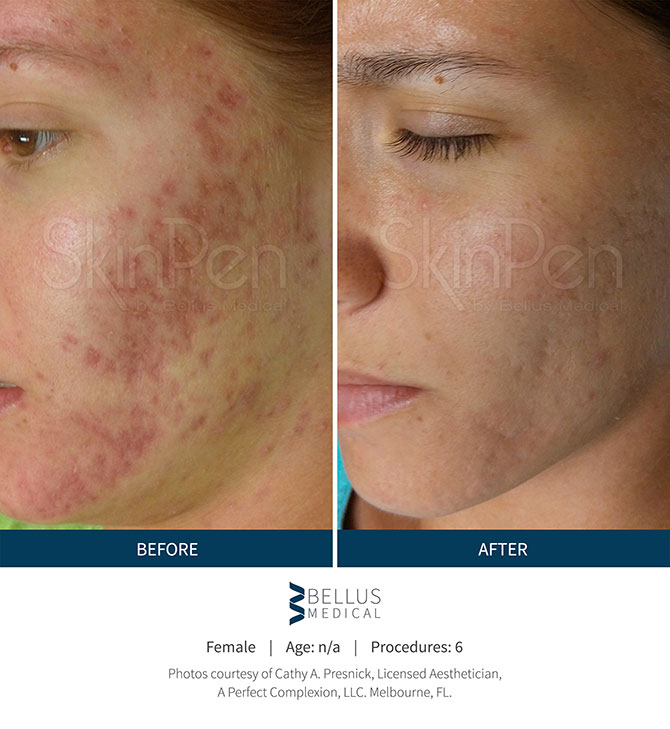 Young Woman Before And After Receiving SkinPen Microneedling