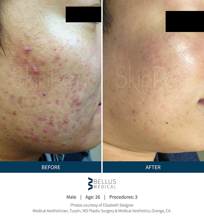 Woman Before And After Receiving SkinPen Microneedling