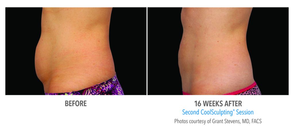 Before and After with Coolsculpting
