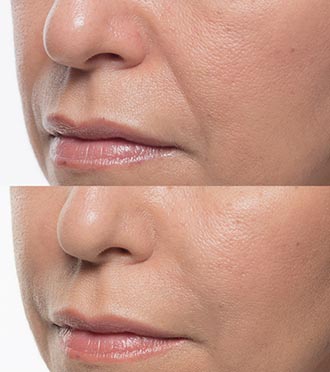 Bellafill Skin Treatment Before & After