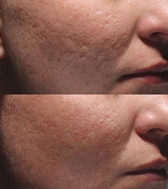 Bellafill Cosmetic Treatment Before & After