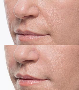 Bellafill Demratology Treatment Before & After