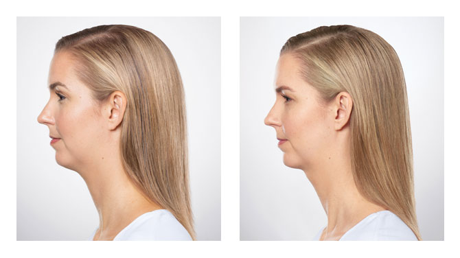 Kybella Before-After 1