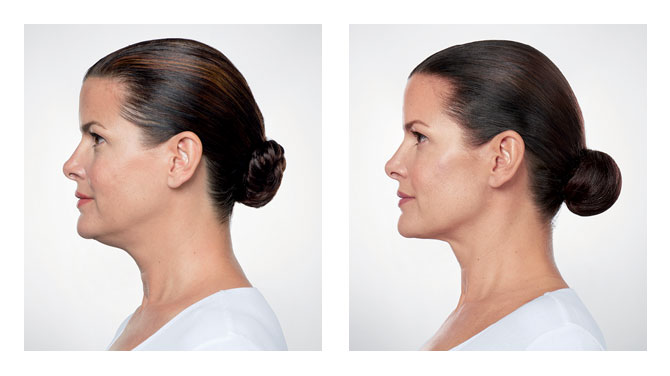 Kybella Before-After 3