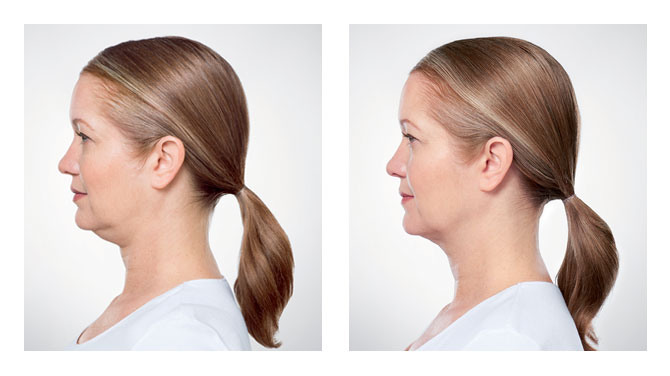 Kybella Before-After 4